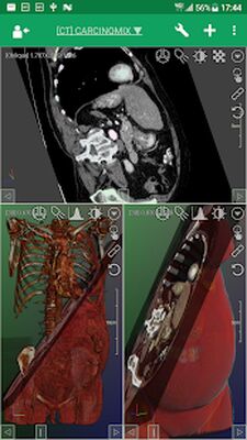 Скачать DroidRender - 3D DICOM viewer [Unlocked] RU apk на Андроид